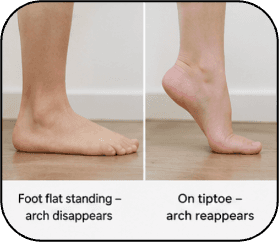 Child standing on tiptoe to assess whether the foot arch appears, a key clinical test for flexible versus rigid flat feet