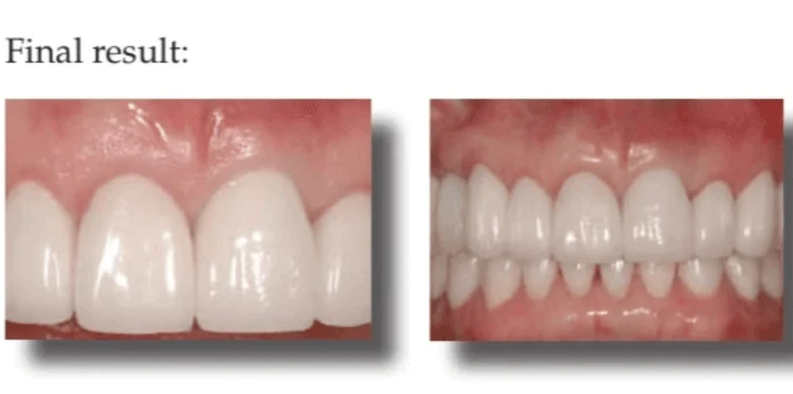 Immediate implants with immediate restorations: A patient-preferred approach | Bloor-Yorkville Periodontics
