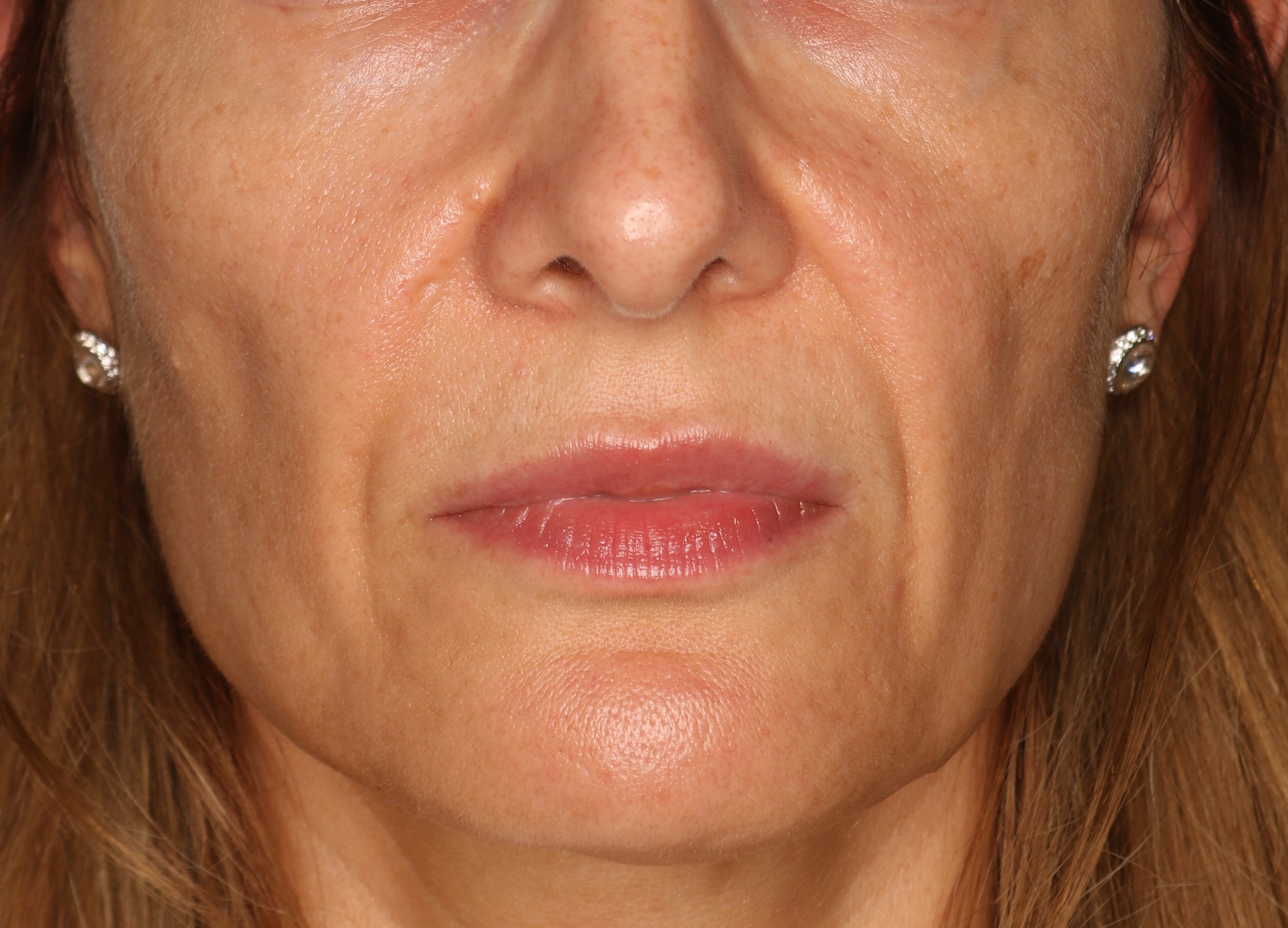 Efekt zabiegu kwas hialuronowy - Przed 3