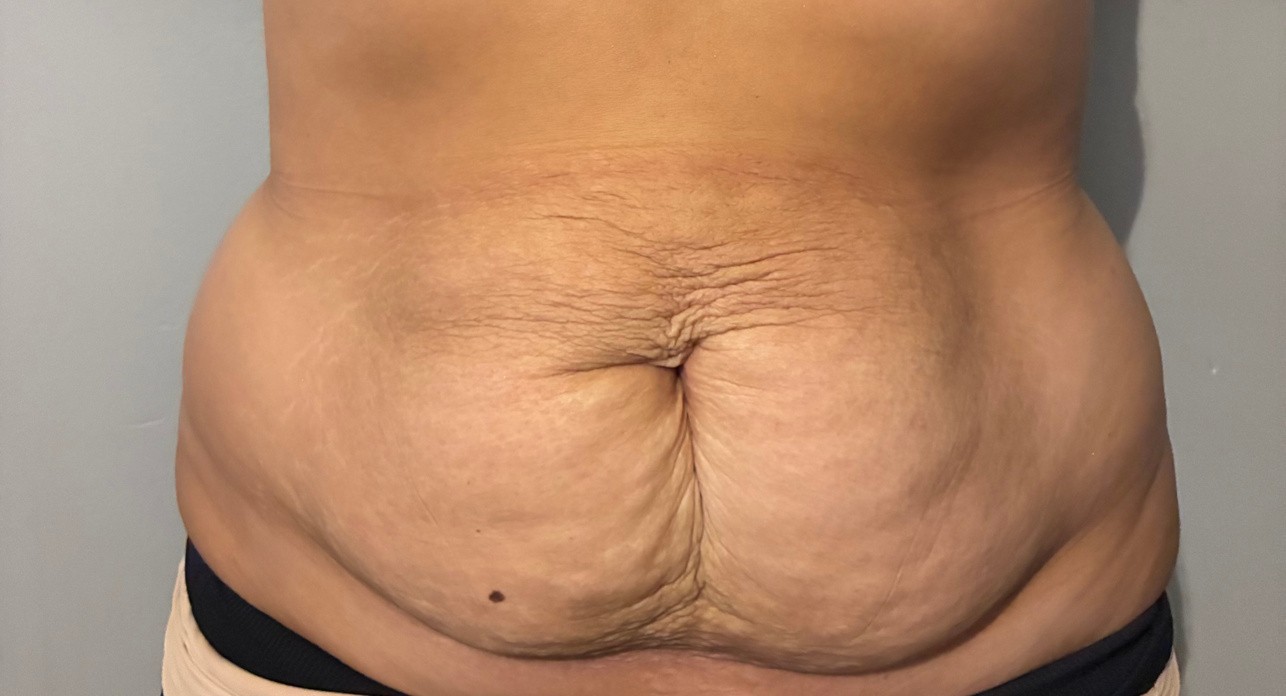 RF microneedling · Abdomen: after treatment