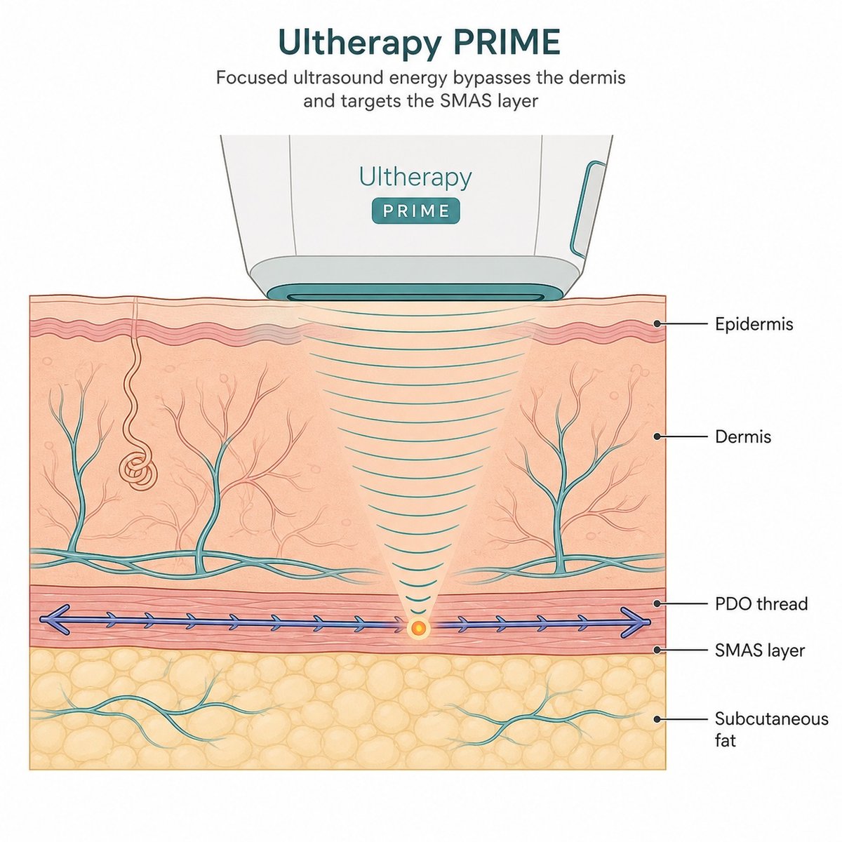 Anatomy cross-section showing HIFU energy delivery relative to thread lift scaffold in facial tissue