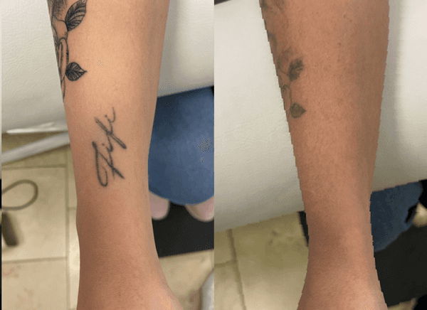 Imagem de antes e depois da remoção de tatuagem