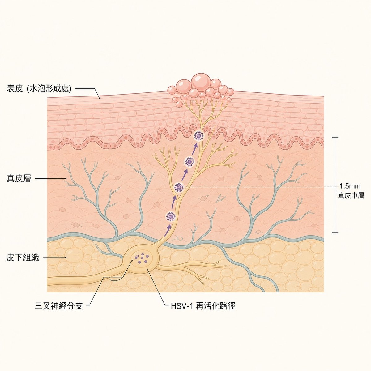 唇皰疹病毒HSV-1沿三叉神經再活化示意圖，顯示從神經節至表皮水泡的路徑