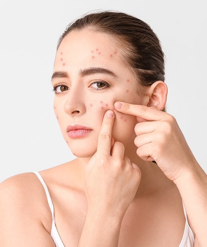 Woman with active acne needing acne treatment