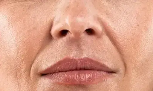 Close-up of mouth area after dermal filler treatment to restore lost volume and smooth static wrinkles around the lips.