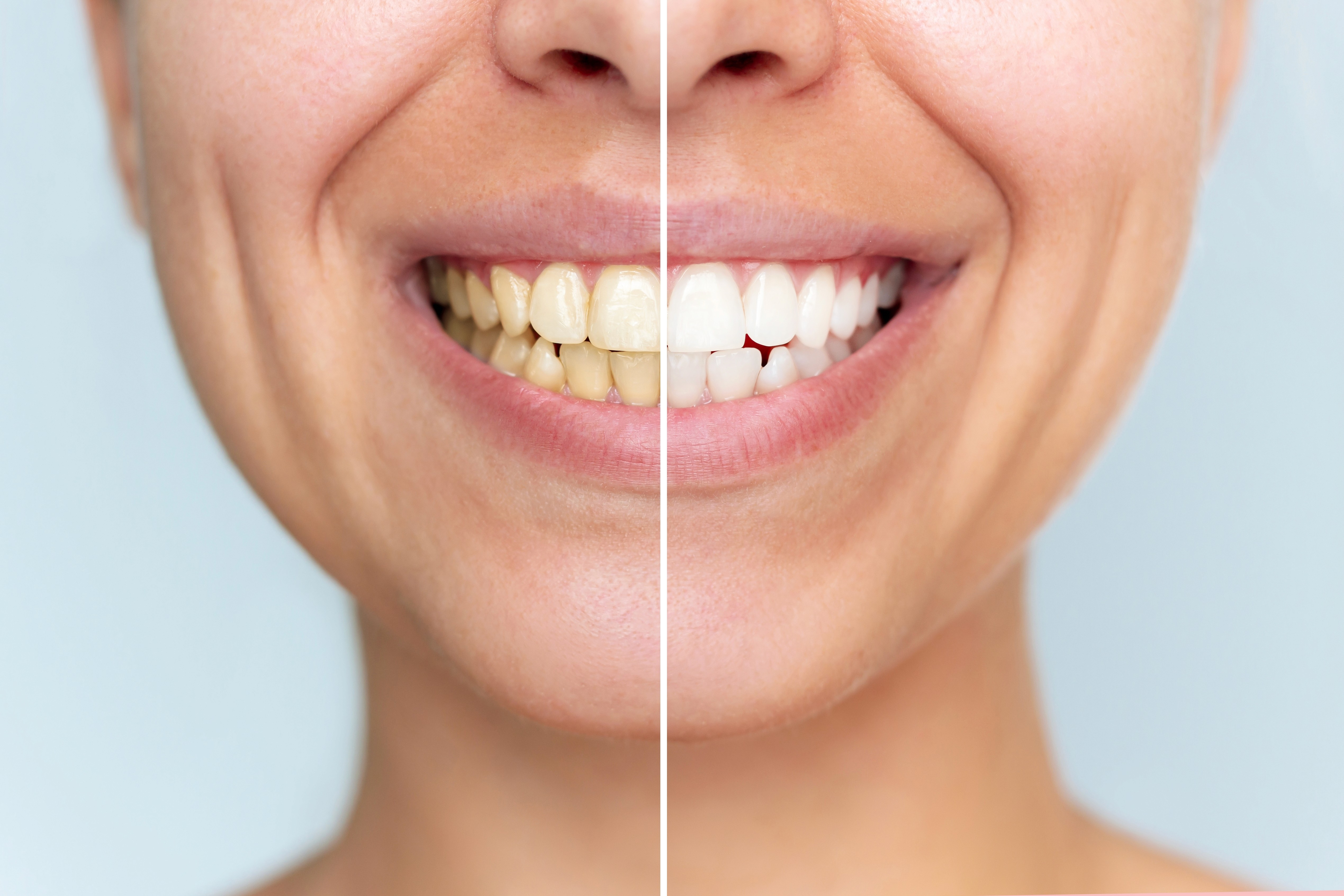 Antes e depois de tratamento para dentes amarelados com melhoria visível da cor e branqueamento dentário profissional