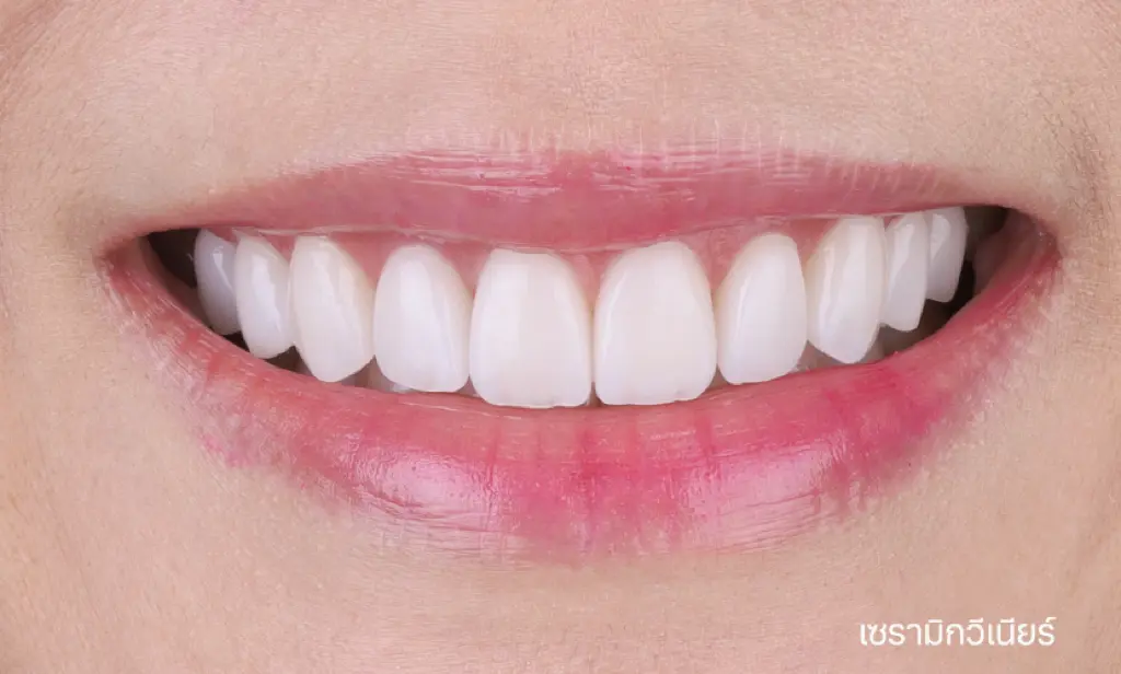 รีวิวออกแบบรอยยิ้มวีเนียร์ cosdent smile design