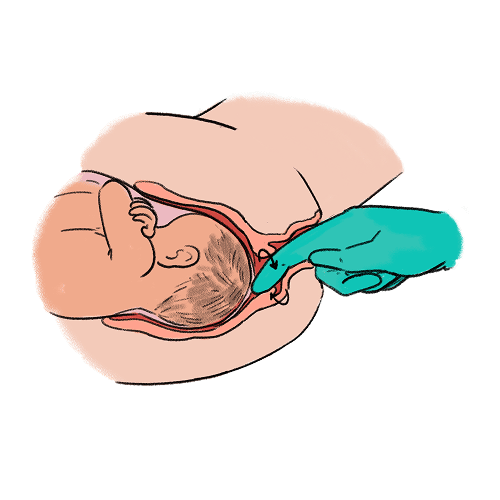 An illustration of a gloved hand using their finger to perform a membrane sweep. The illustration shows how the finger moves in a circular motion at the neck of the cervix.
