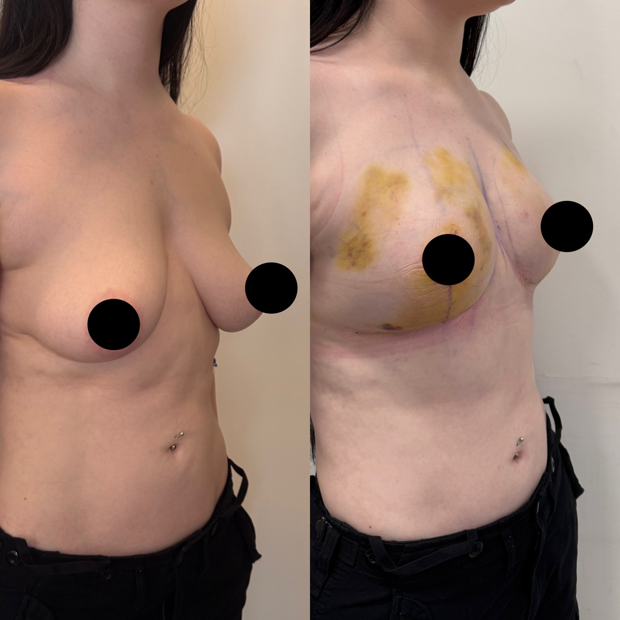 breast lift and fat injection before after right oblique view