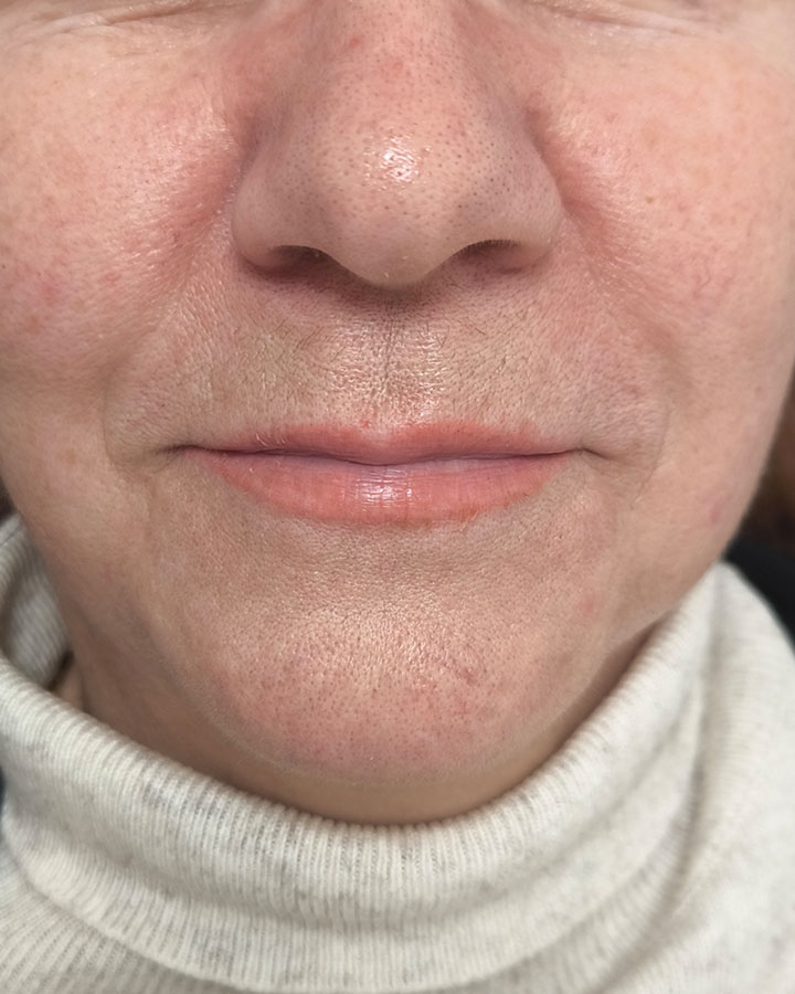 Úzka a zaniknutá horná pera v zrelom veku pred estetickou korekciou