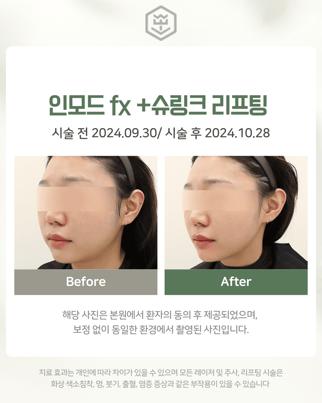 인모드fx+슈링크리프팅