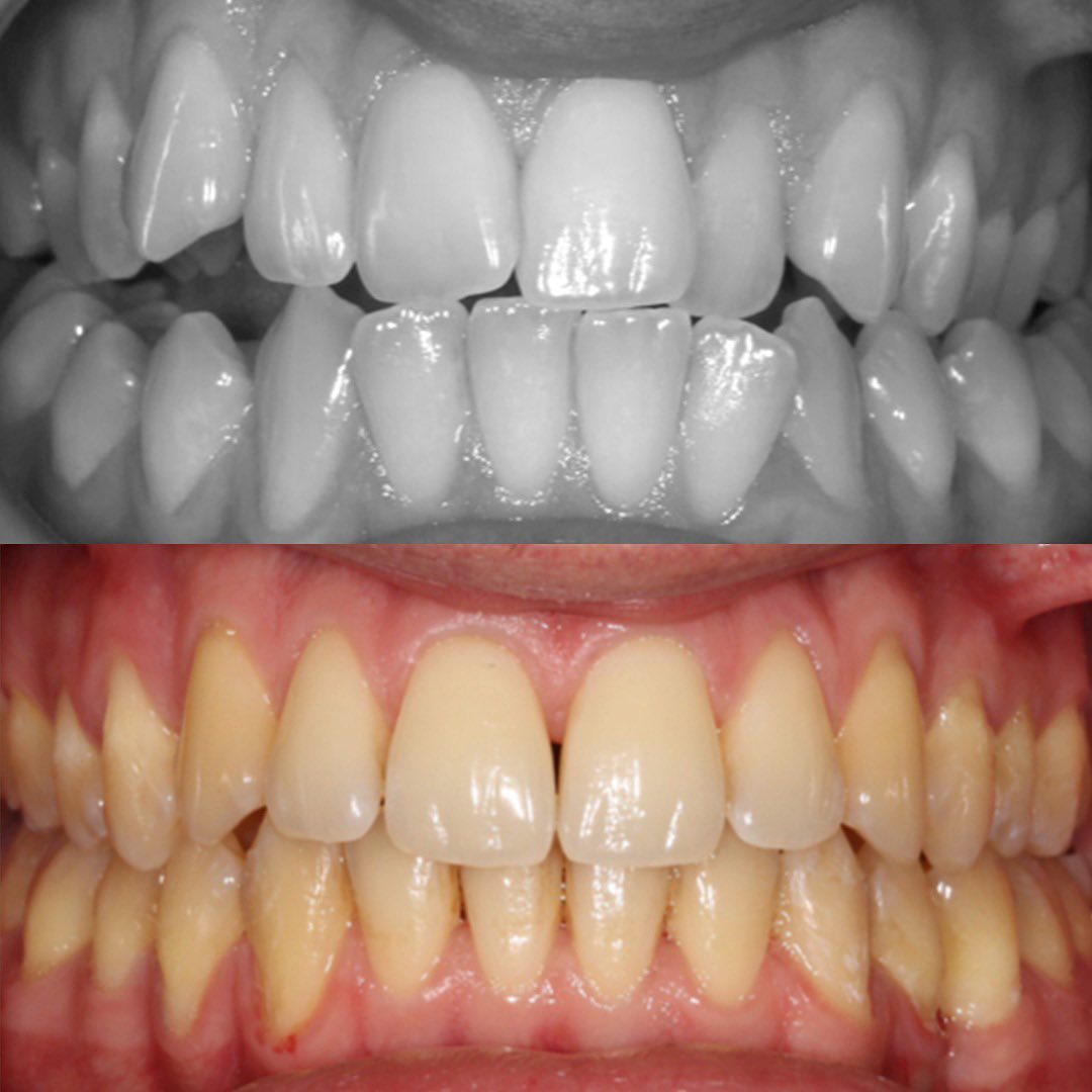 Invisalign® before and after photo at Invisalign Center in Dubai, revealing the shift from crooked teeth to a straight smile.