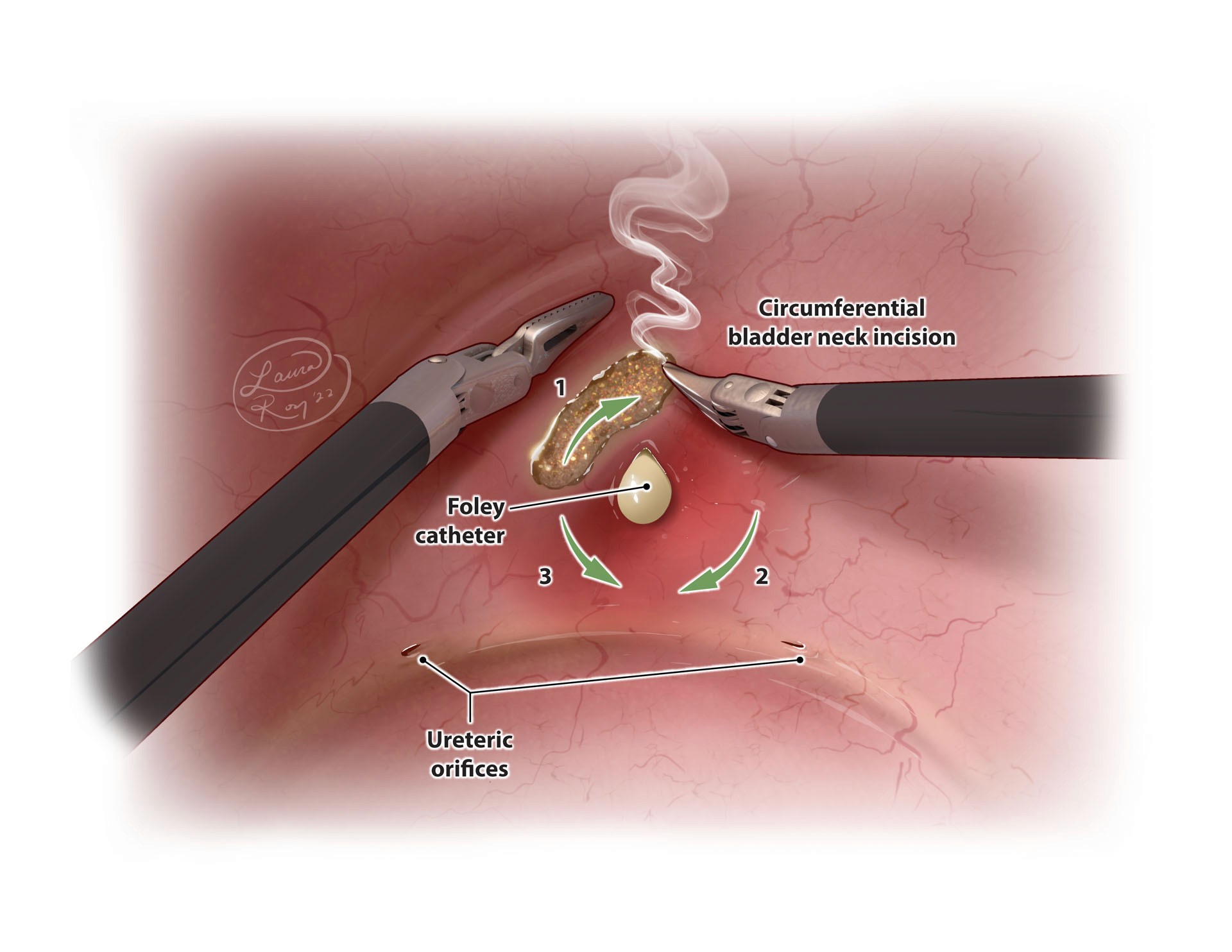 Transvesical Prostatectomy Suite