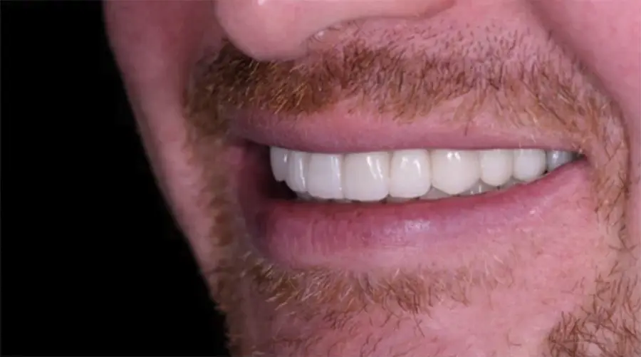 Patient smile after single tooth implant treatment showing a restored, natural-looking tooth replacement and improved smile appearance.