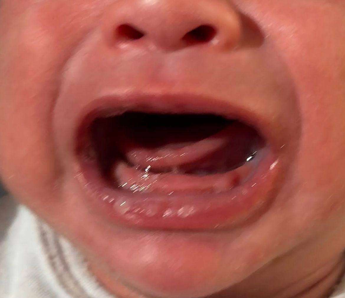 Frenillo lingual corto