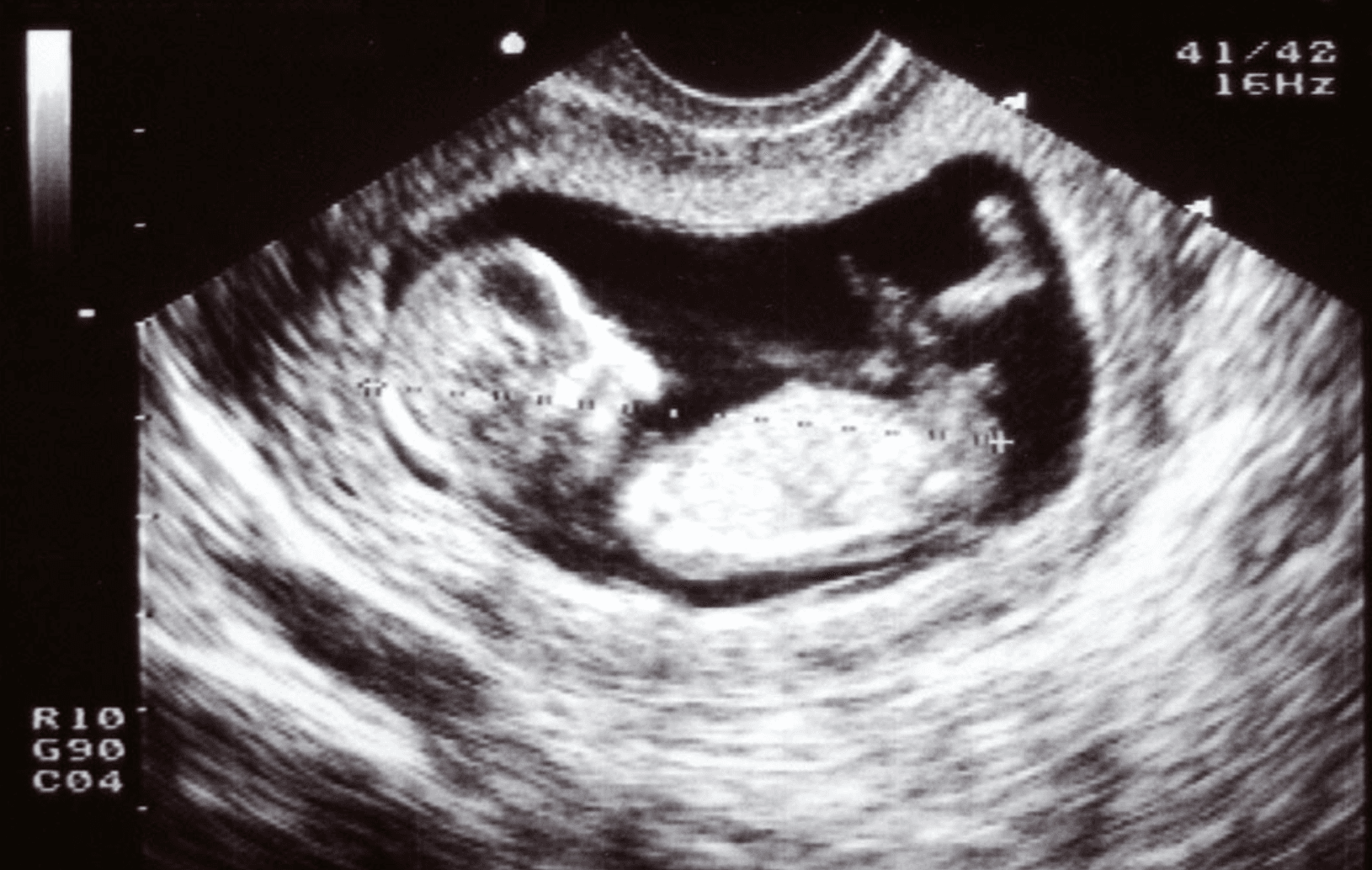 ภาพอัลตราซาวด์ทารกในครรภ์แบบ 2 มิติ แสดงทารกในระยะตั้งครรภ์ช่วงต้น