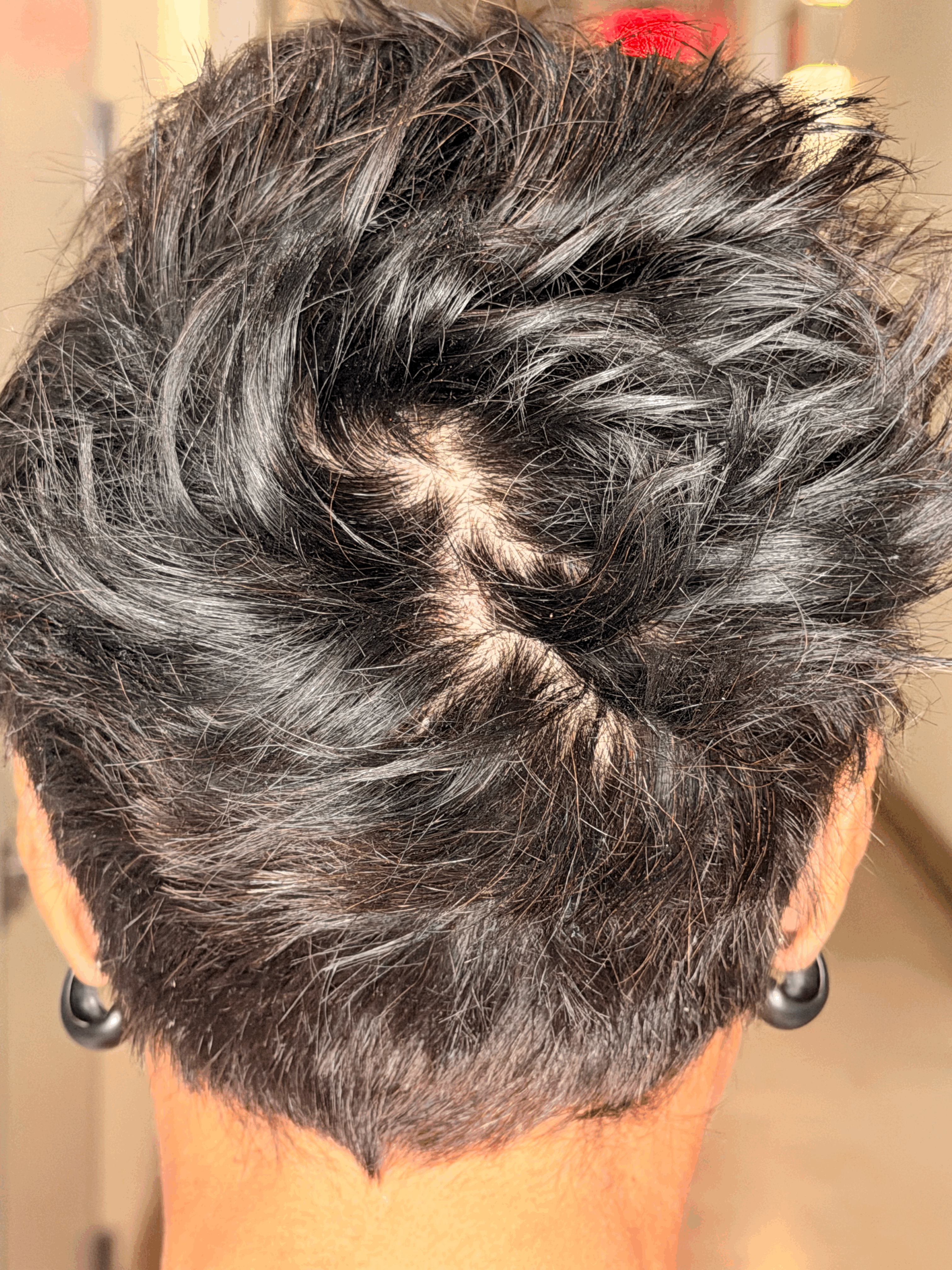 Before hair regrowth progress photo
