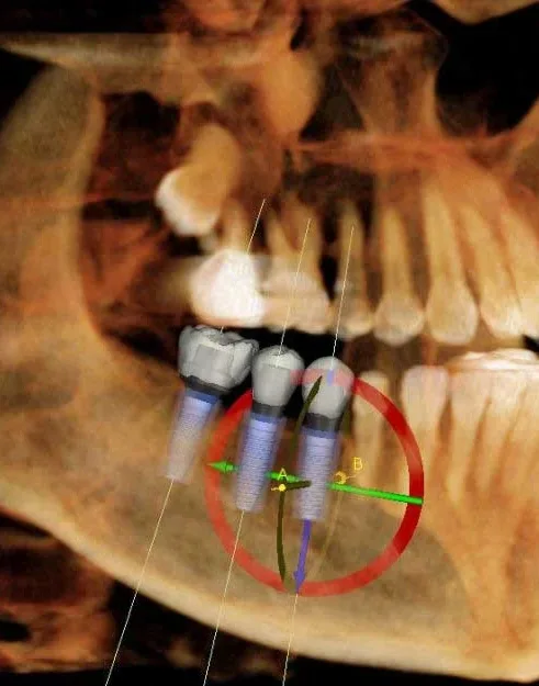 3D imaging for dental implants
