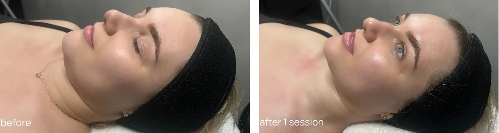 before and after cryo facial