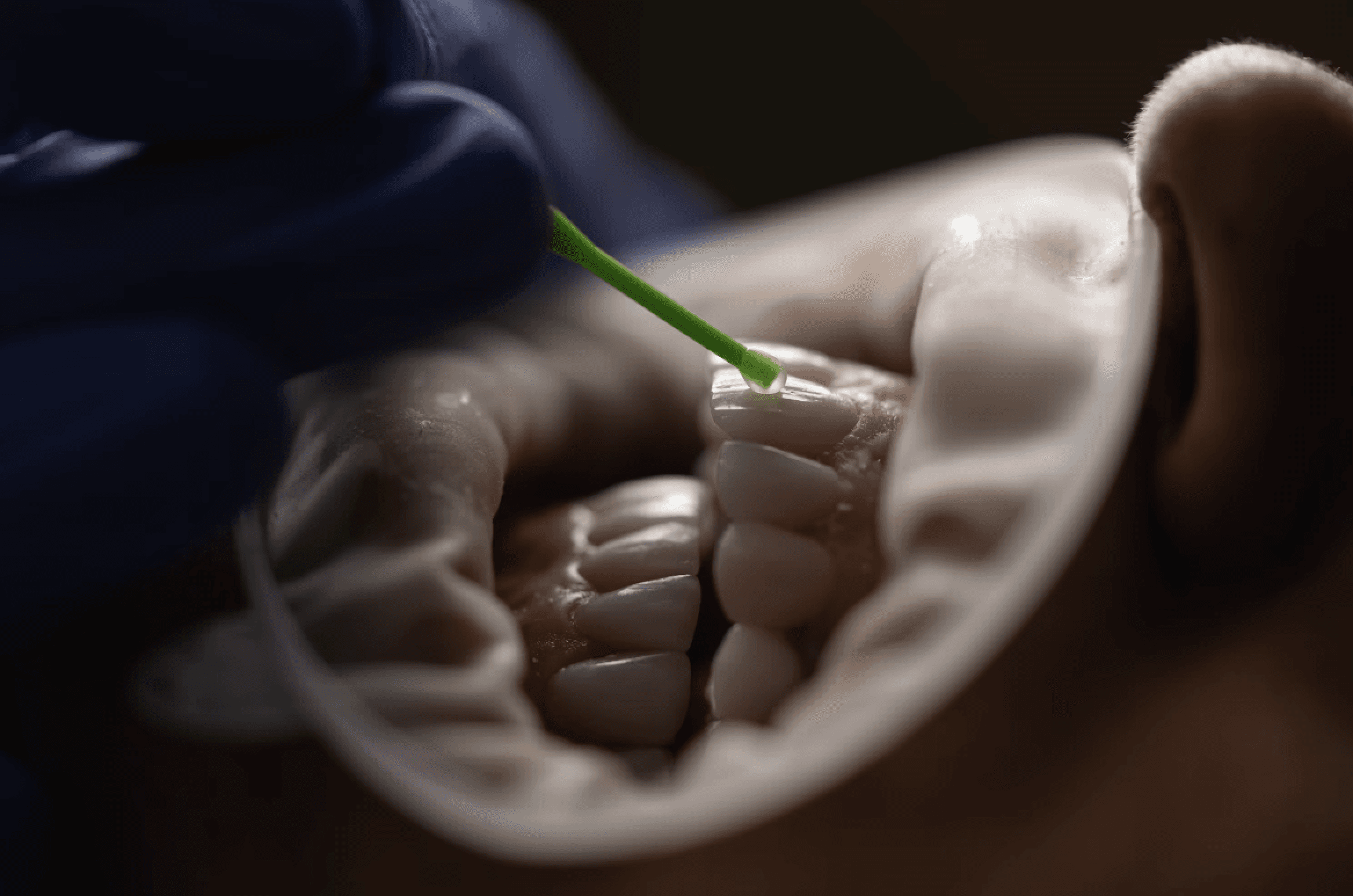 Tandarts die vulling plaatst bij patiënt.