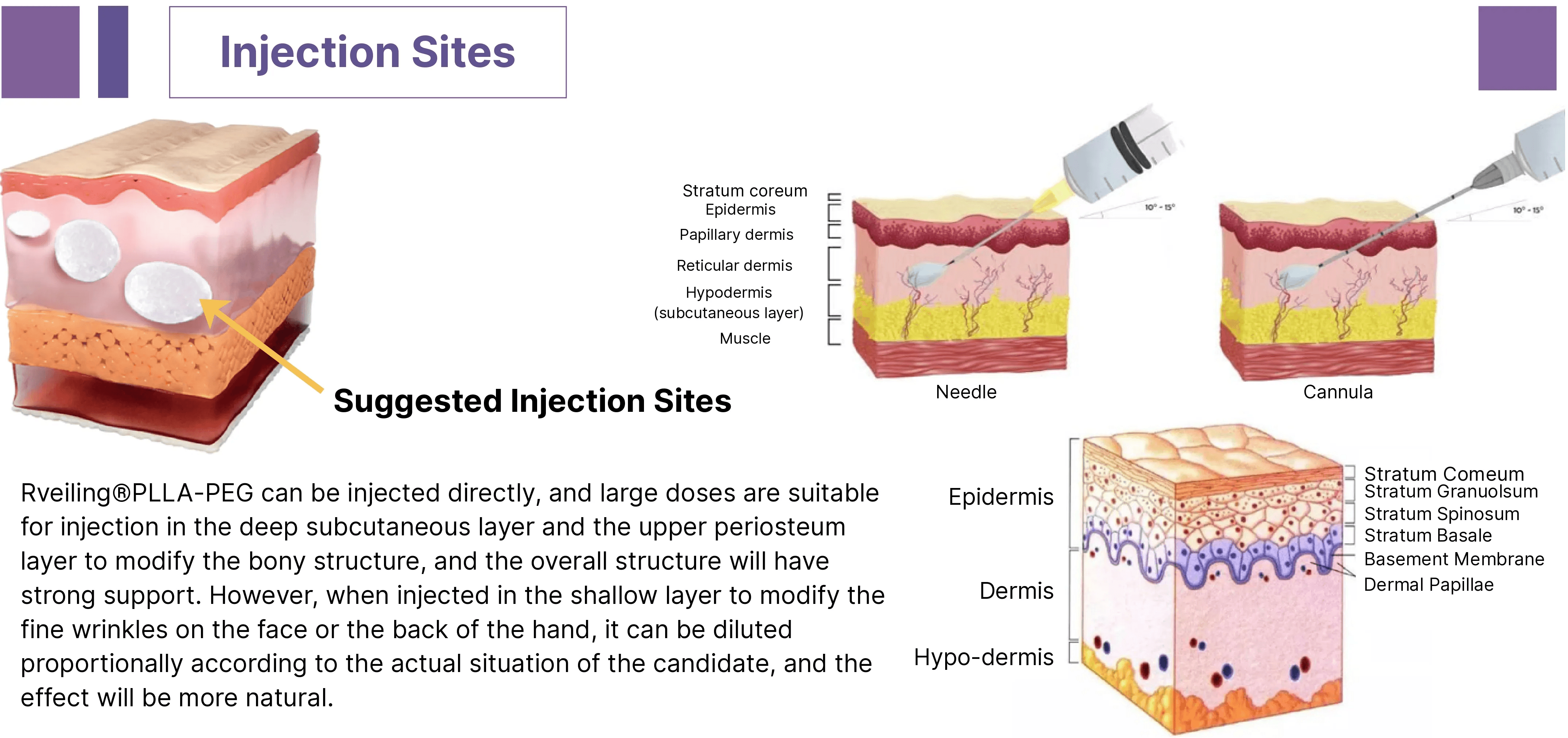 Recommended injection sites for PLLA-PEG facial fillers
