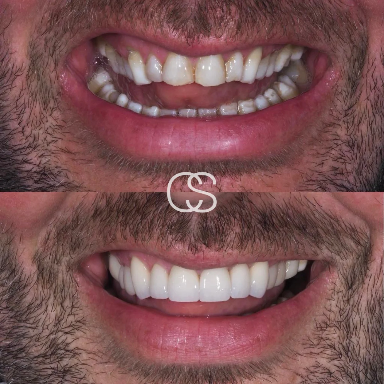 Before & After Veneers at Colac Smiles, Colac