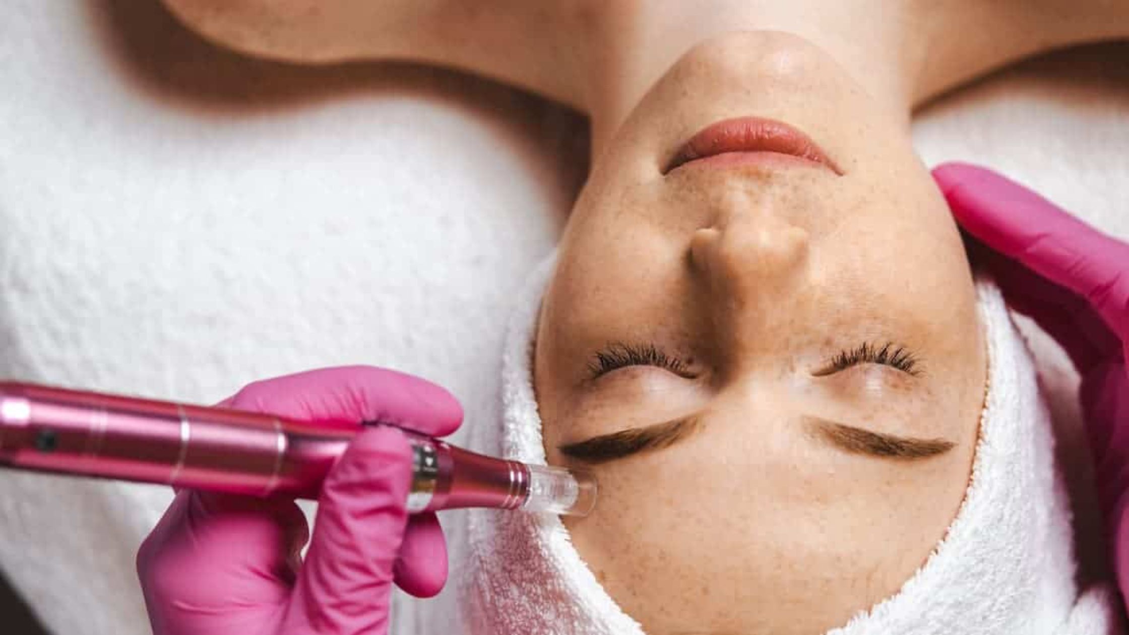 Microneedling vs. Other Skin Treatments