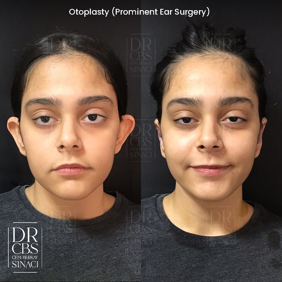 1st day result before after prominent ear otoplasty 