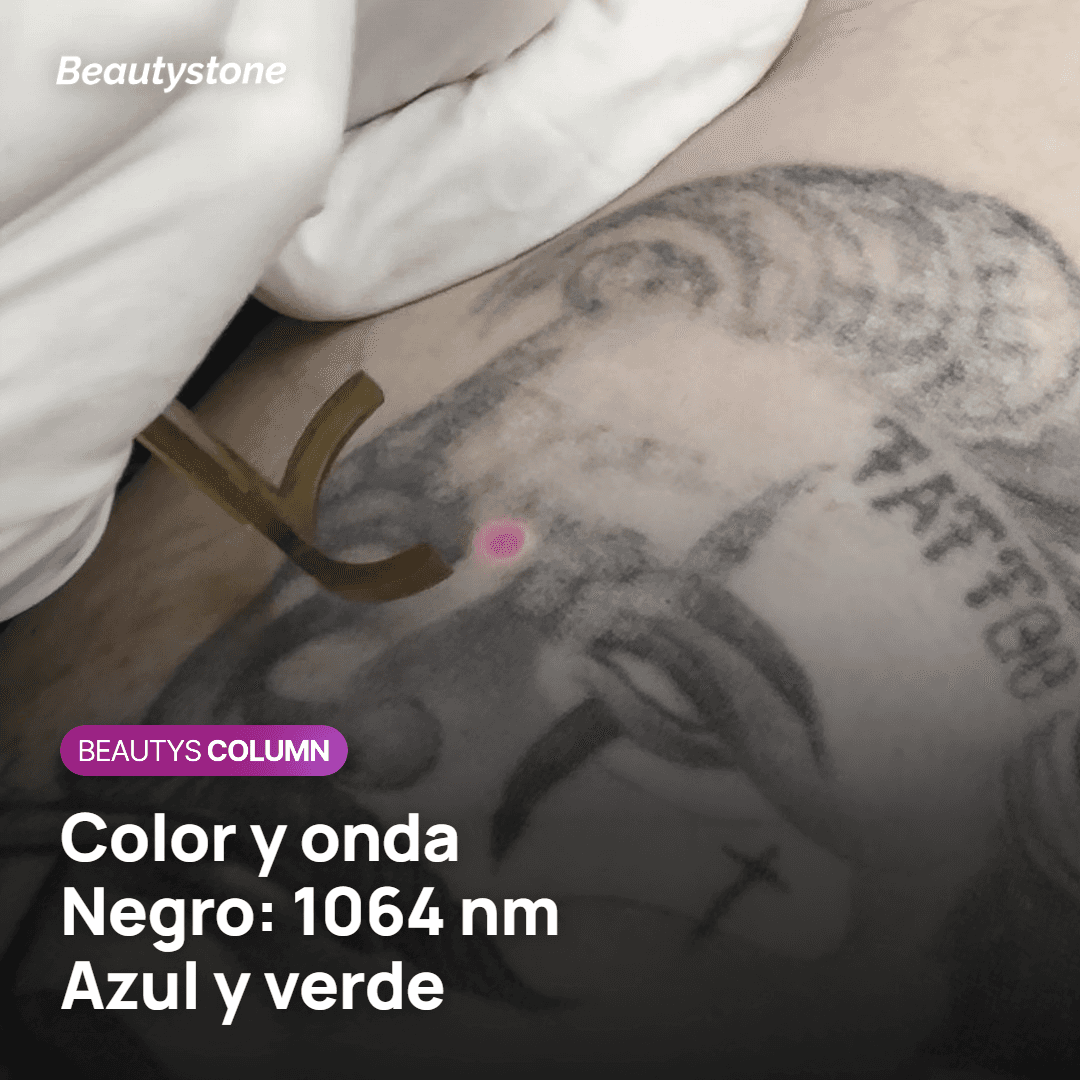 Caso de eliminación láser de un tatuaje irezumi