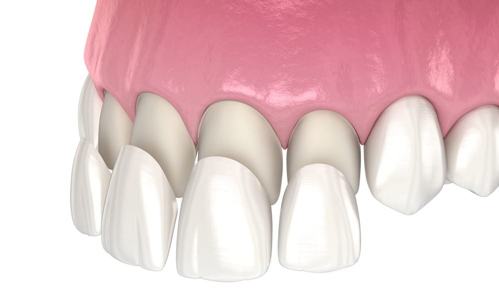 Porcelain veneers dental cosmetic treatment