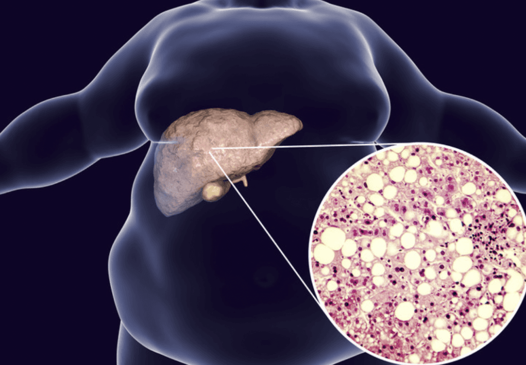 medical illustration of liver health related to weight and metabolism