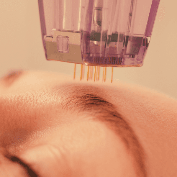 Close up image of Sylfirm X treatment performed on woman's forehead