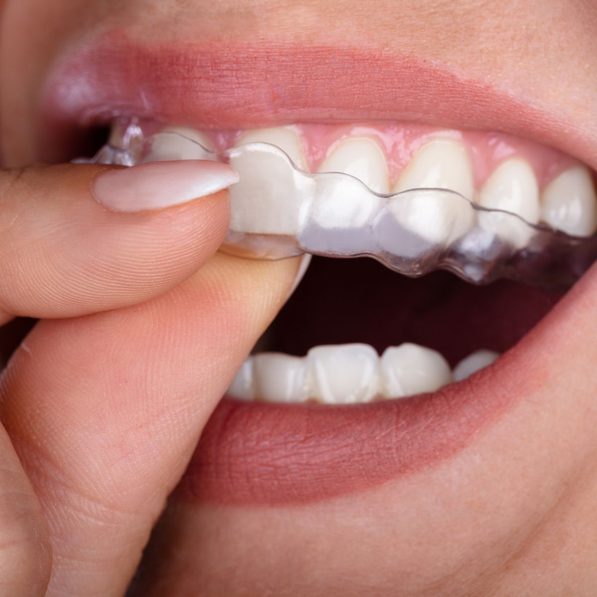 Invisalign in Hurghada - Sun Clinics