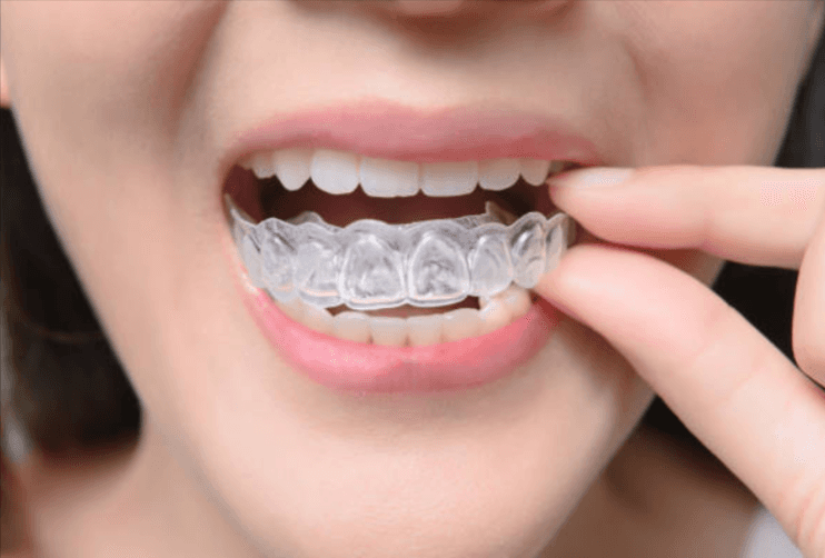 Woman smiling, about to wear teeth retainers