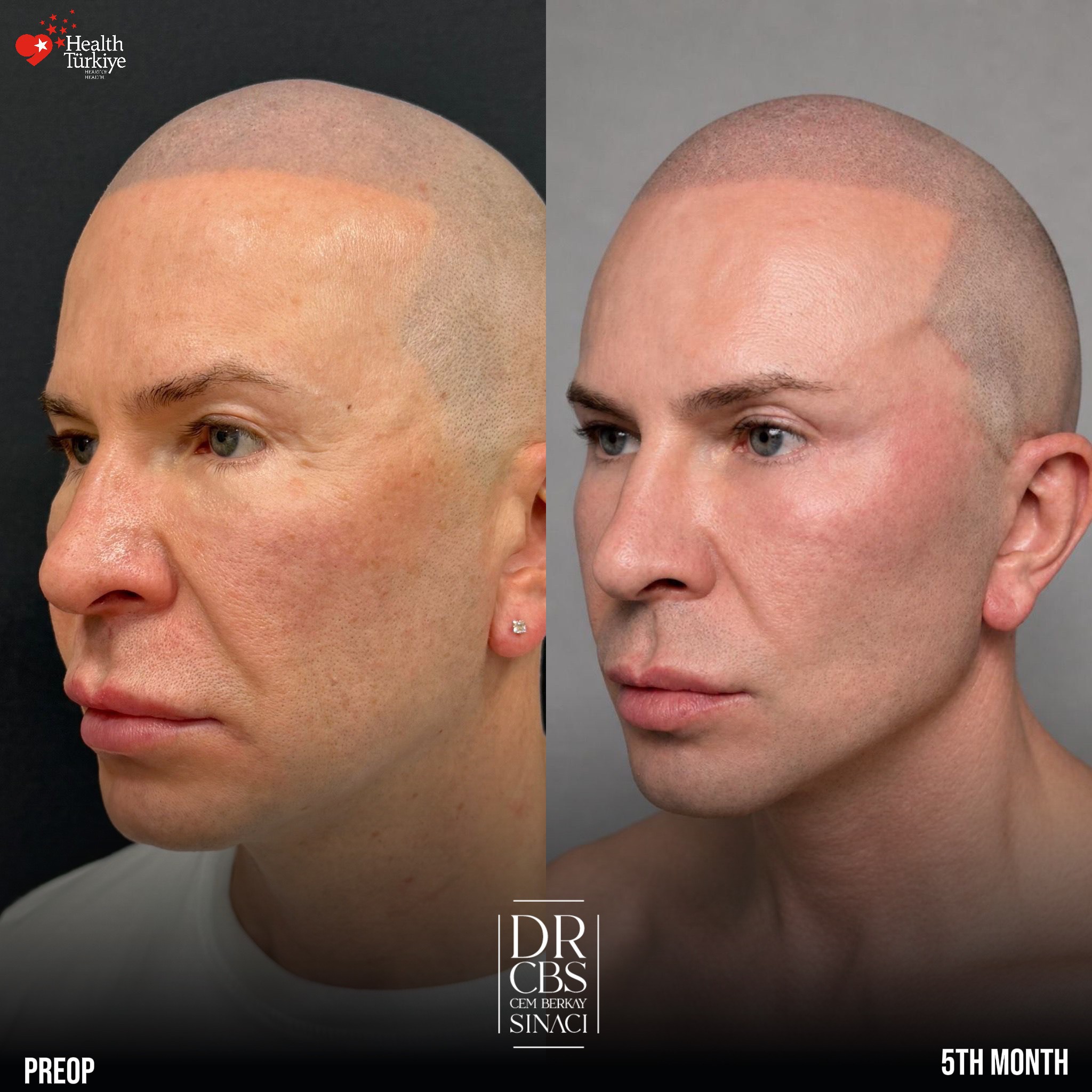 male facelift deep plane before aftter oblique view