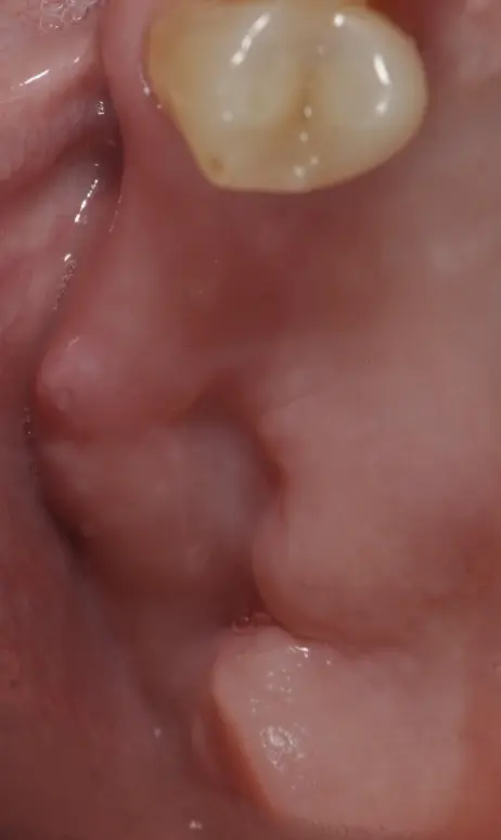 Deux implants remplaÇant des dents postérieures manquantes
