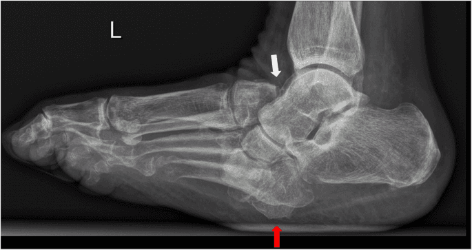 x-ray of charcot foot reconstruction