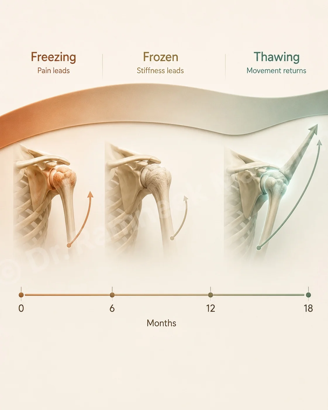 A frozen shoulder moves through freezing, frozen and thawing over about 12 to 18 months, often shorter with treatment.