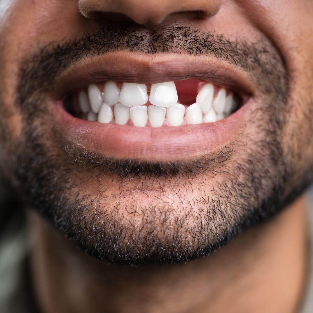 Smile restoration with dental implants at Dentistree Dental Clinic Kolkata.