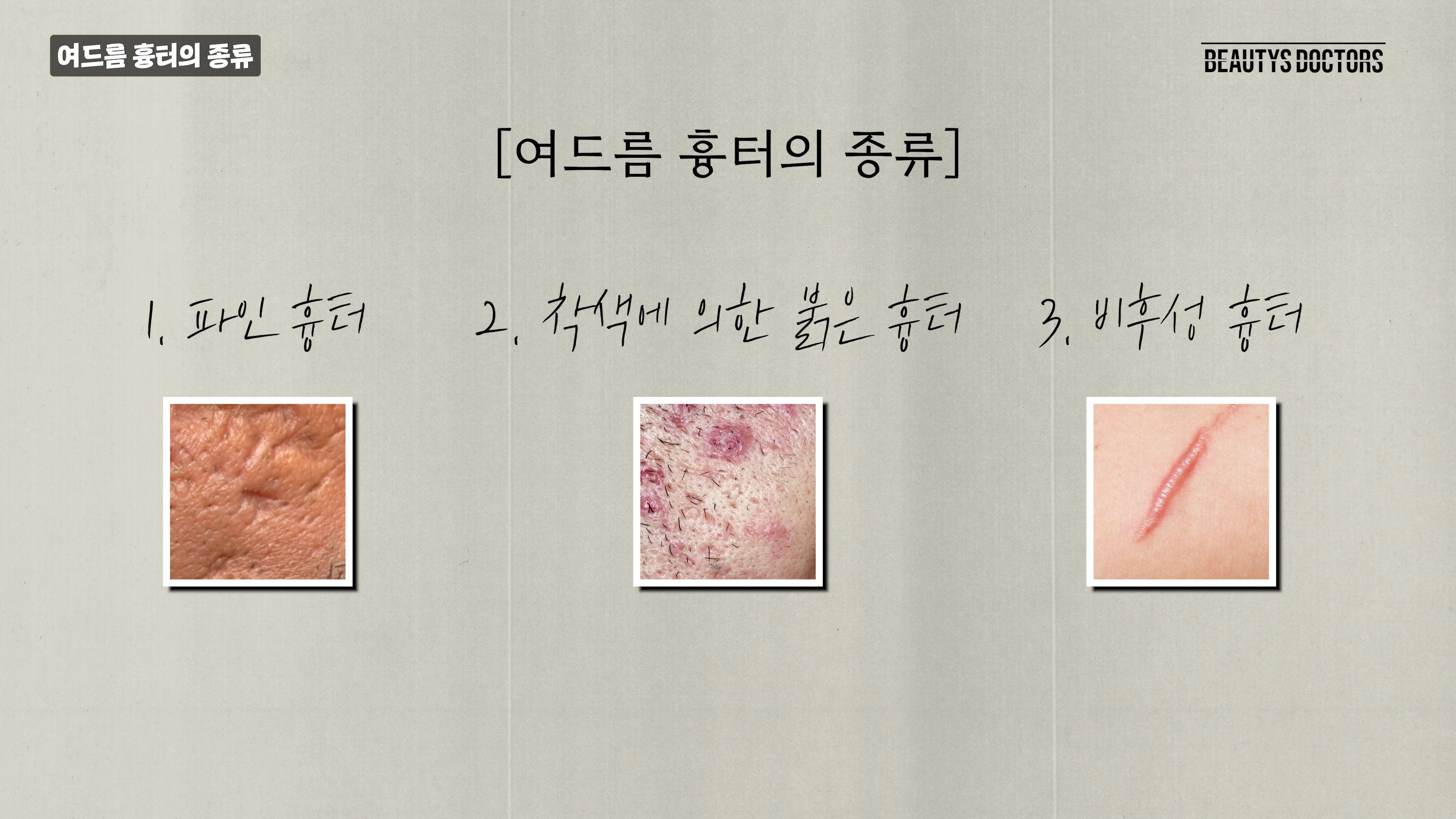 여드름 흉터 치료, 큐어젯과 레이저 병행이 필요한 이유