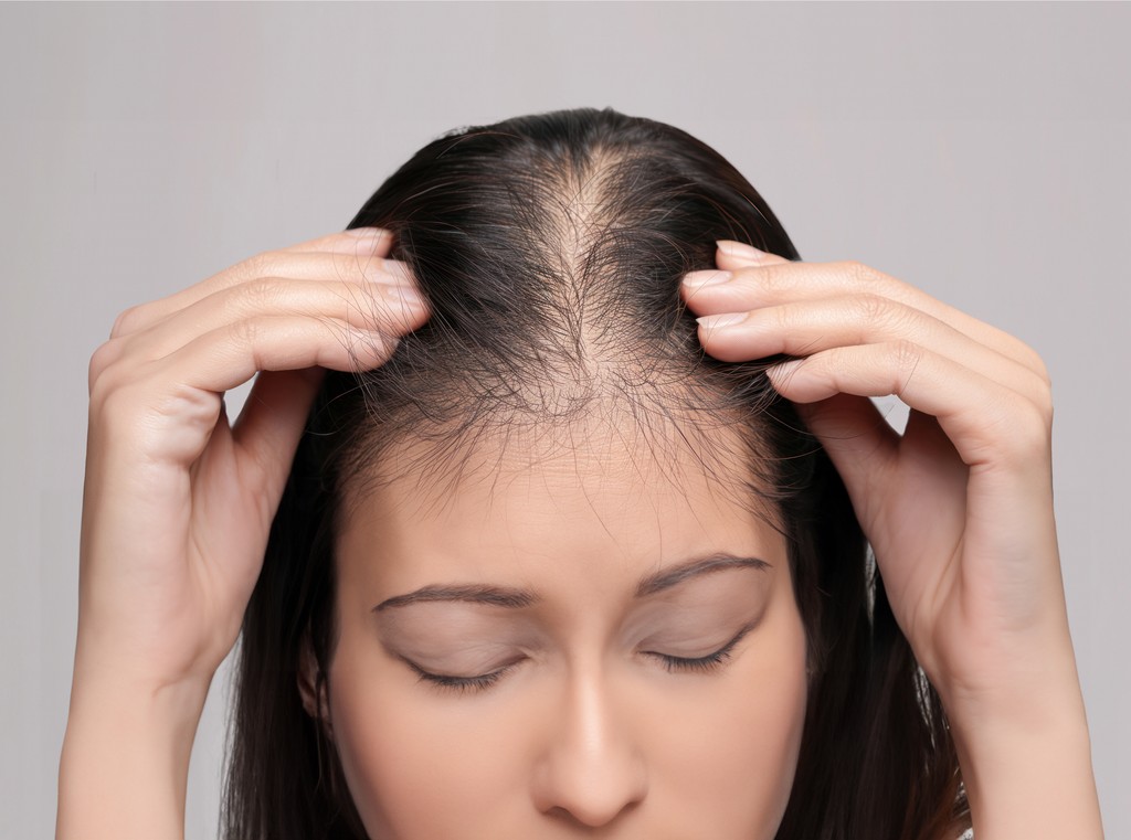 Women's Hair Loss