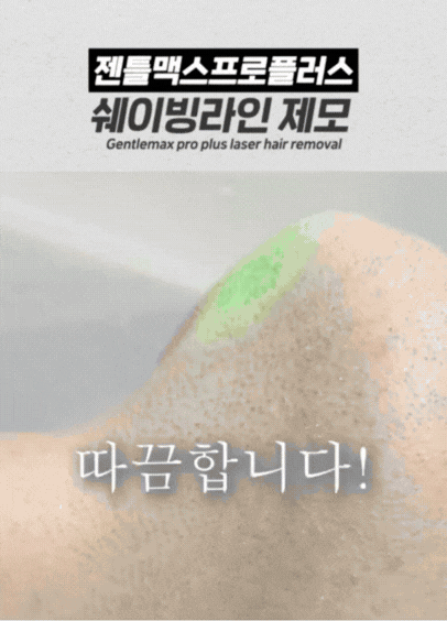 수염자국없애는법 레이저 시술 전후 비교