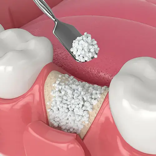 bone grafting