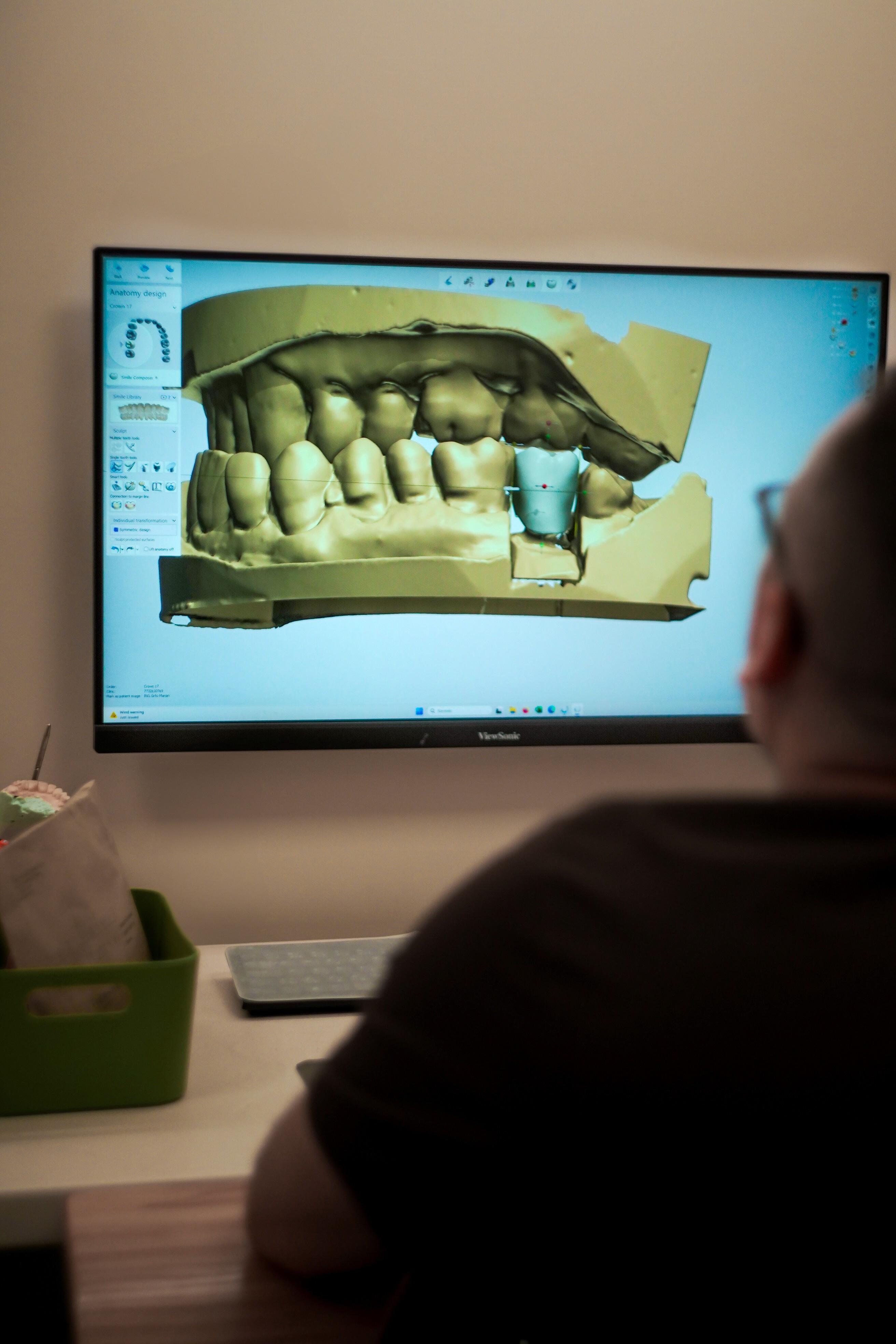 Detail CAD/CAM frézovacieho procesu v systéme Amann Girrbach