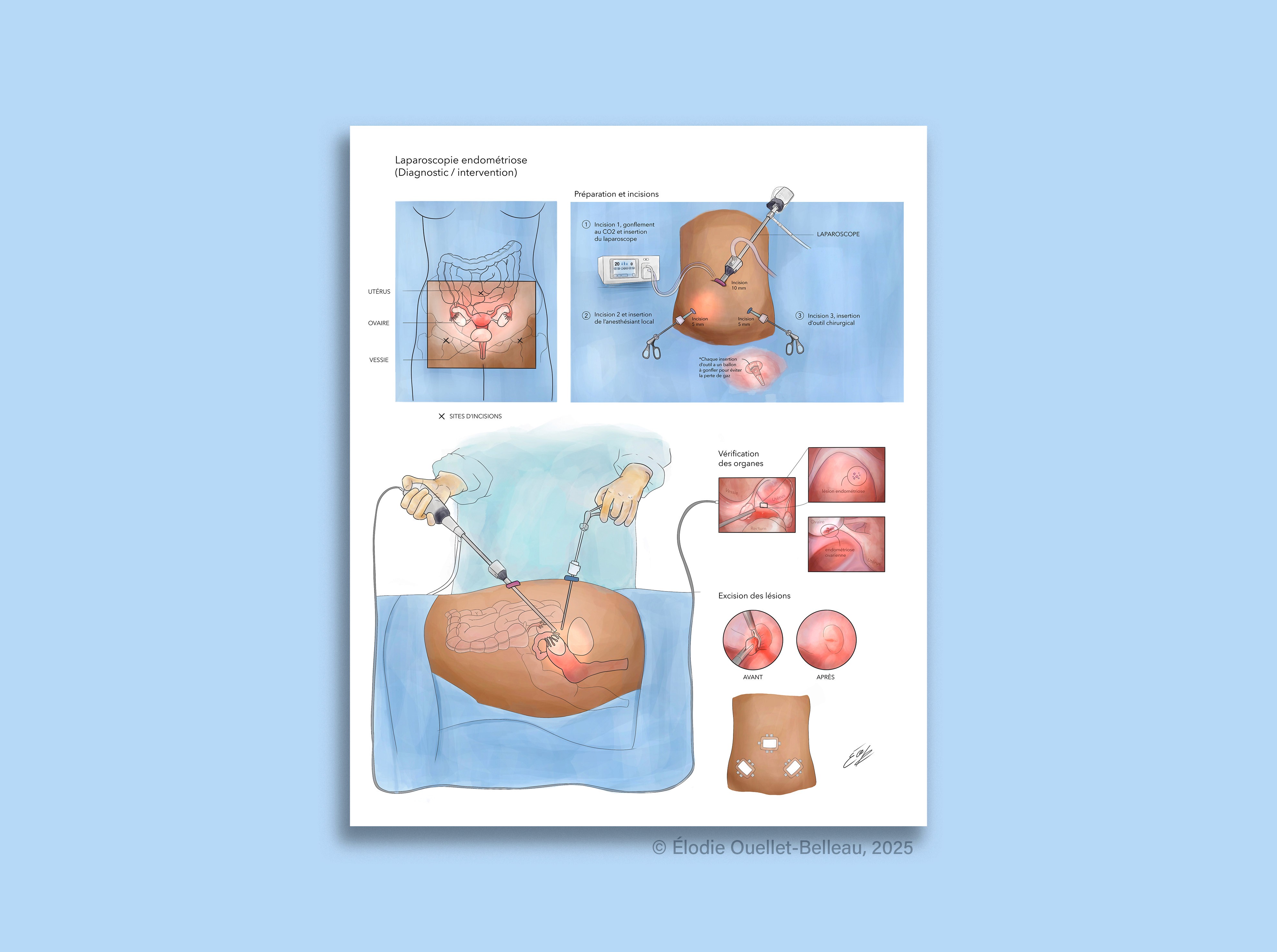 Mockup du projet Laparoscopie Endométriose par Élodie Ouellet-Belleau