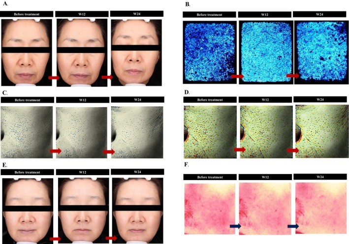 clinical results of belotero revive skin booster