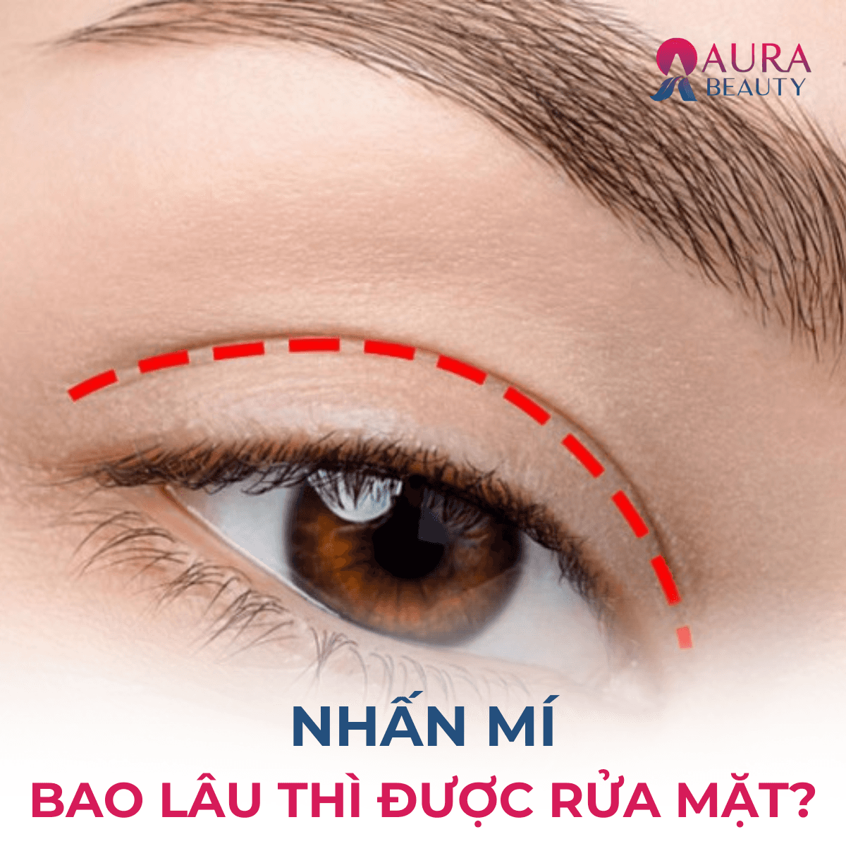 Nhấn mí bao lâu được rửa mặt