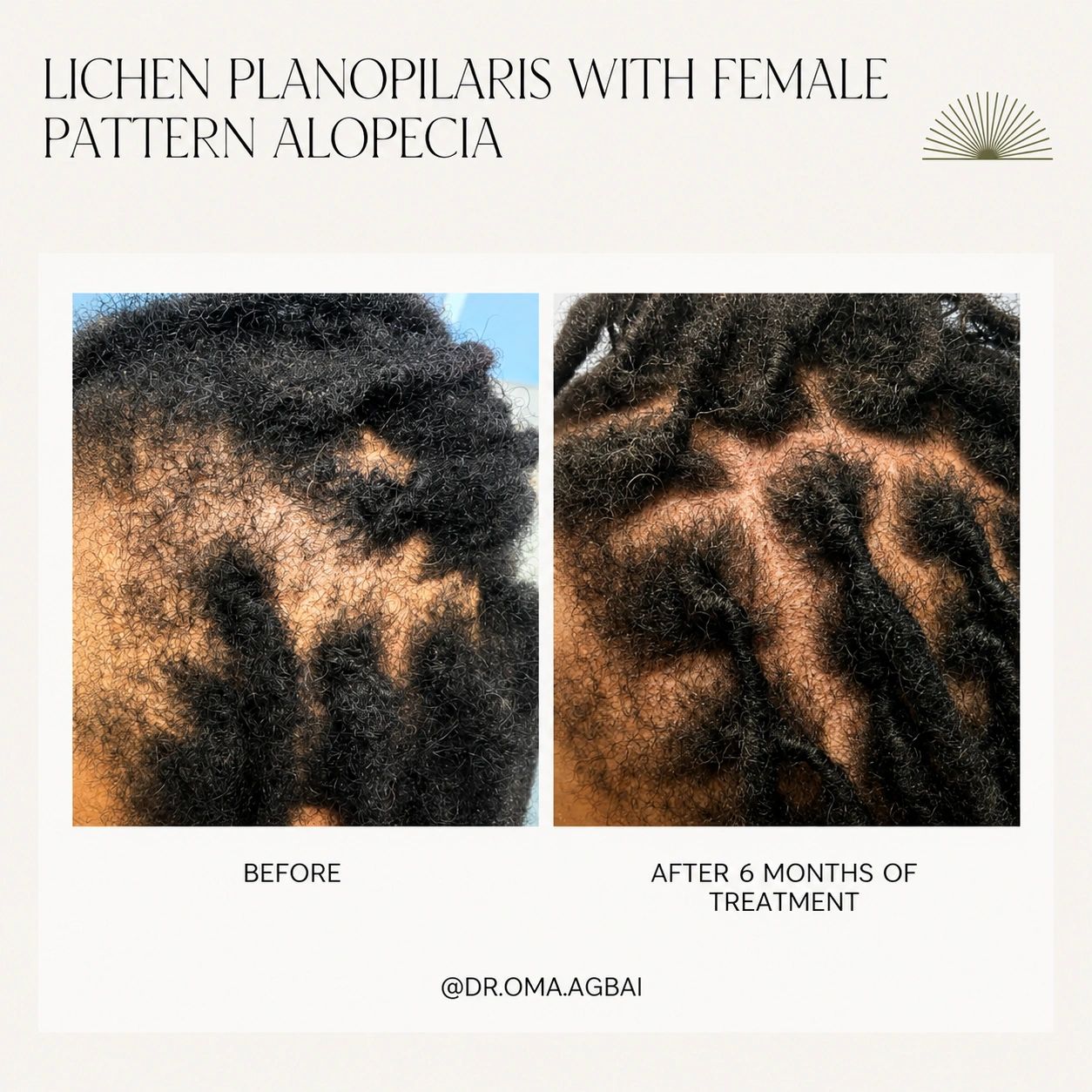 Lichen planopilaris with female pattern hair loss: before treatment on the left; after 6 months on the right.