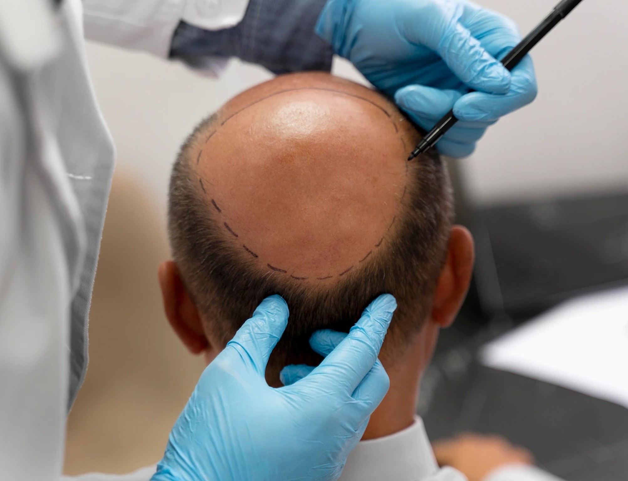 Follicular Unit Transplantation (FUT) Follicular Unit Extraction (FUE) Hair Transplant