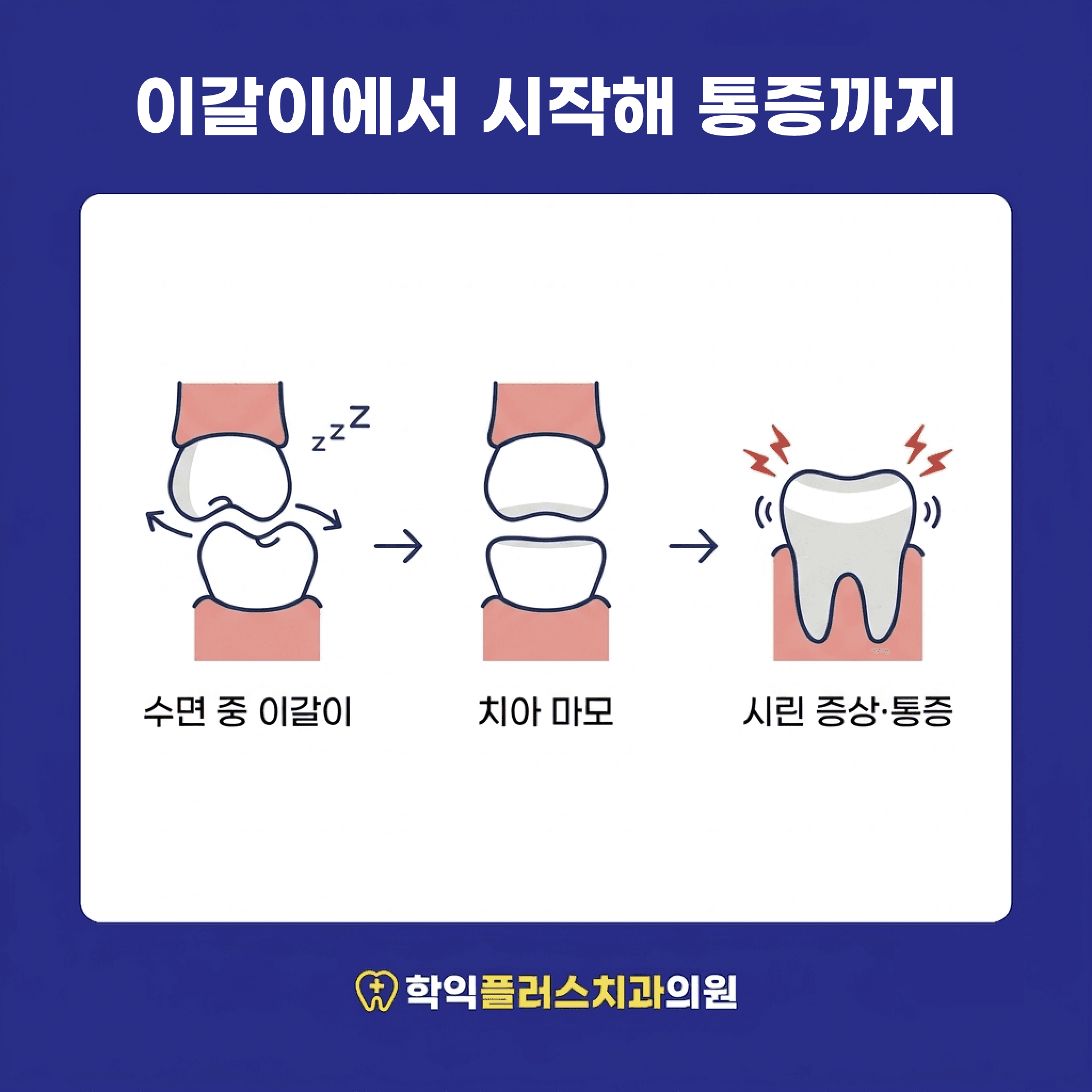 이갈이에서 이어지는 흐름 — 마모가 진행되면 시린 증상이나 통증으로 나타남